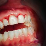 Diş Etlerim Çok Görünüyor Bunun İçin Nasıl Tedavi Yapabiliriz?