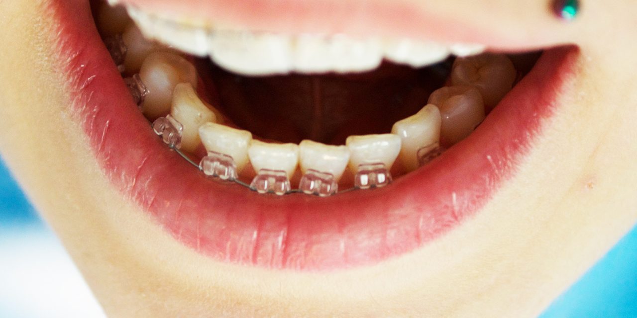Ortodontik Tedavi Kalıcı Bir Tedavi midir?